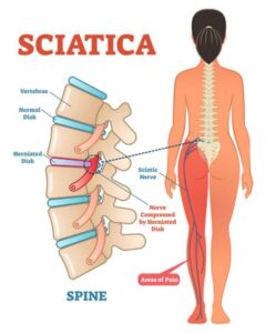 Illustration of lower back pain